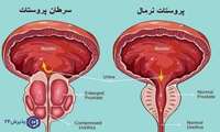 آقایان سرطان پروستات را جدی بگیرند