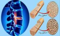 پوکی استخوان یک بیماری خاموش و مزمن